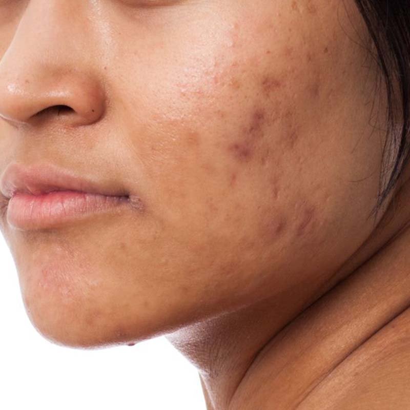 Remove-Acne-Marks.jpg