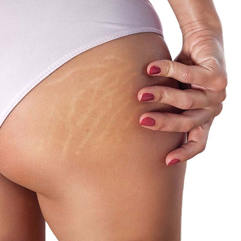 stretch-marks.jpg