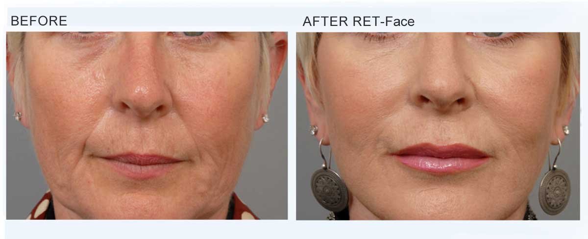 Peface machine therapy before after