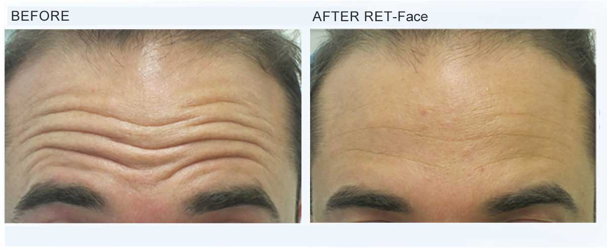 Peface machine therapy before after