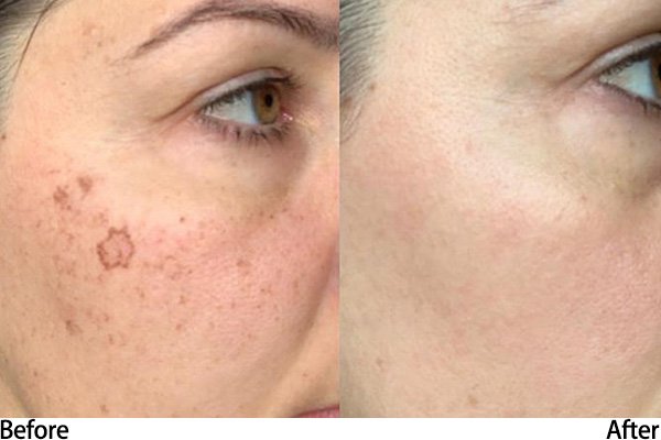 Picoway Laser Machine Treatment Before after
