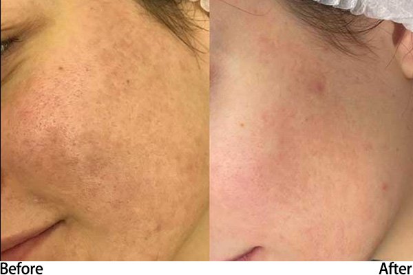 Picoway Laser Machine Treatment Before after